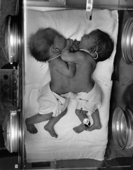 (1678) Medical, Siamese Twins, Michigan, Undated (1678) Medical, Siamese Twins, Michigan, Undated
